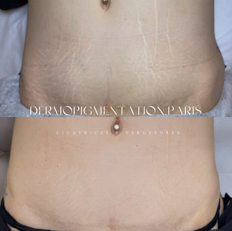 Résultat Dermopigmentation Paris : découvrez en images l’impact immédiat de nos soins de camouflage et maquillage permanent.