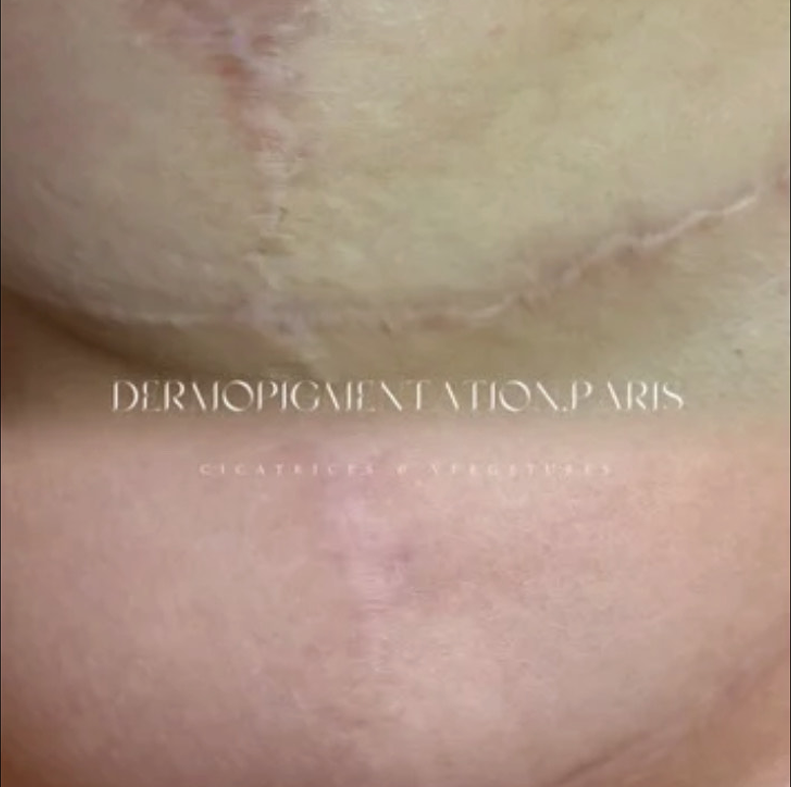 Résultat Dermopigmentation Paris : découvrez en images l’impact immédiat de nos soins de camouflage et maquillage permanent.
